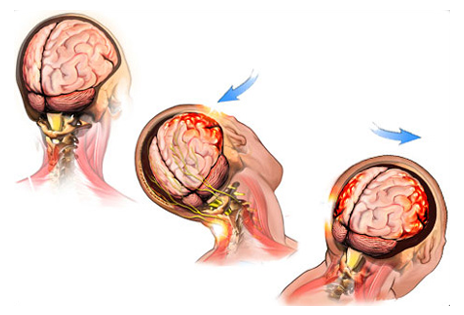Movement of head causing trauma to the brain.